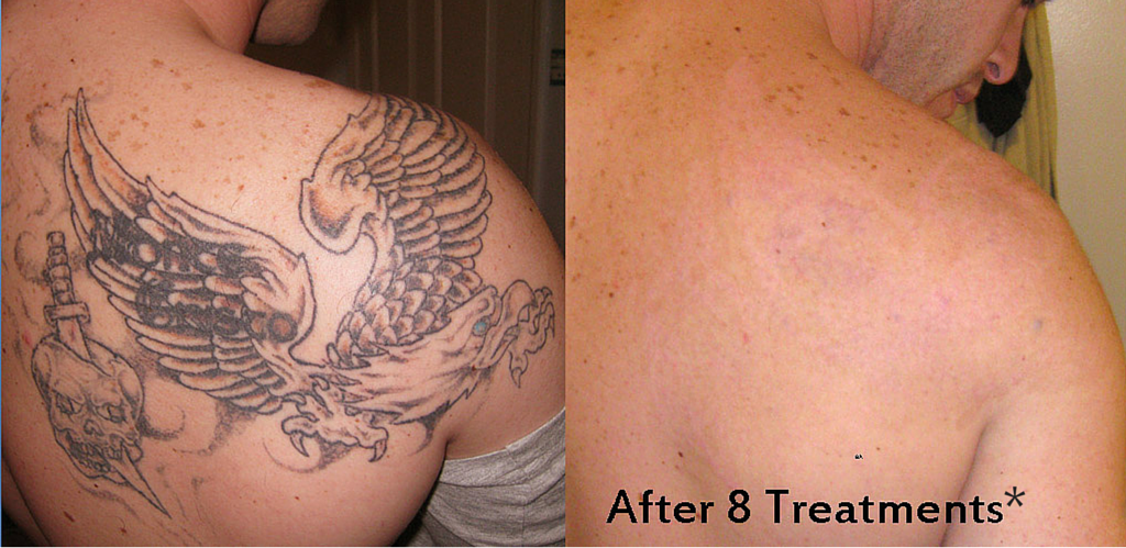 Tampa Tattoo Removal services | Weight and Body Solutions