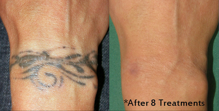 Tampa Tattoo Removal services | Weight and Body Solutions