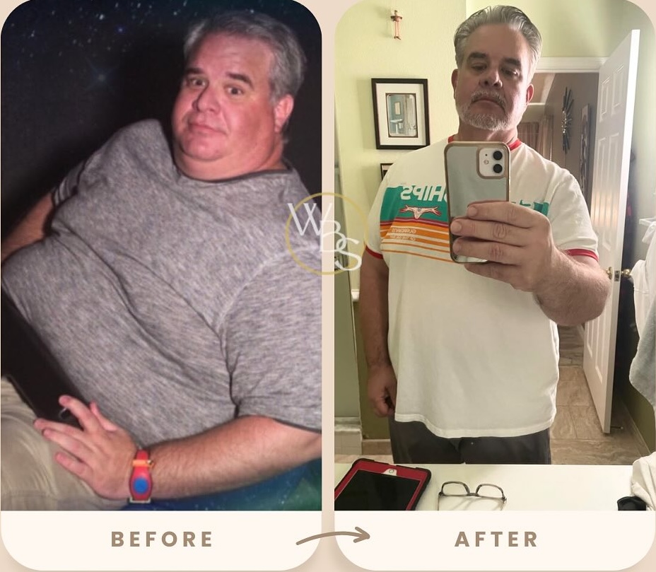 Before and After Weight Loss Transformation at Weight and Body Solutions Tampa Bay
