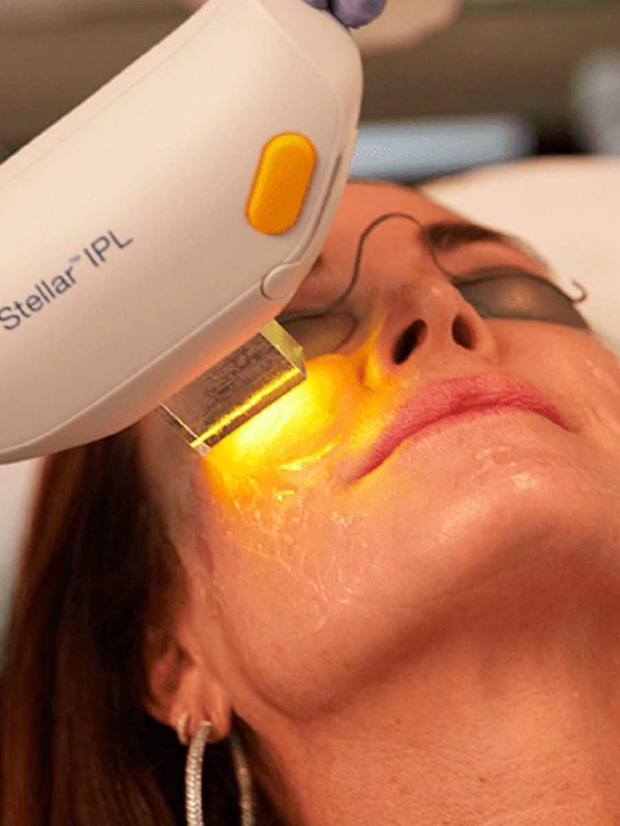 IPL Photofacial