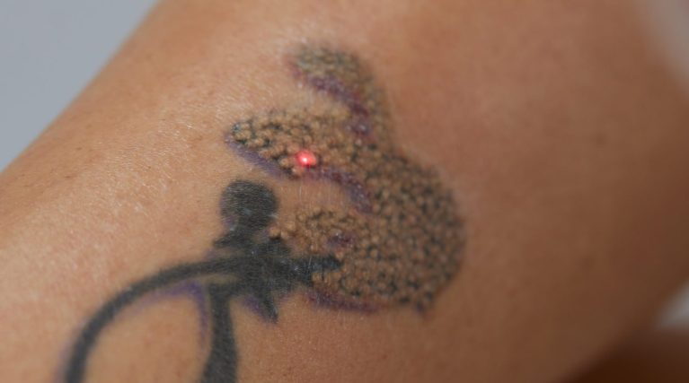 Young woman undergoing laser tattoo removal procedure in salon, closeup