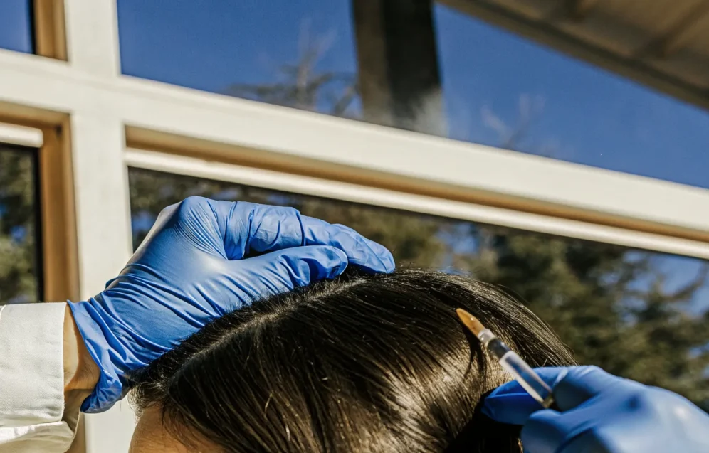 plasma-injections-for-hair-loss-featured